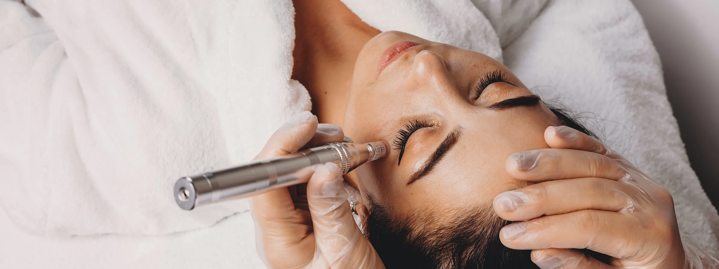 Kundin erhält eine Microneedling Behandlung im Gesicht